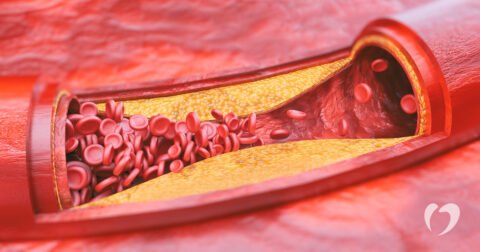 atherosclerosis