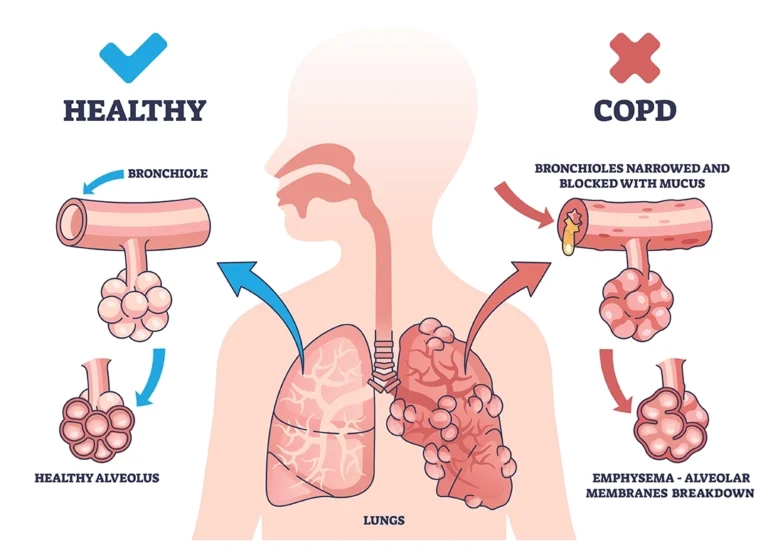 bronchitis