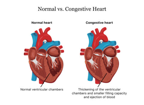 congestive heart failure treatment