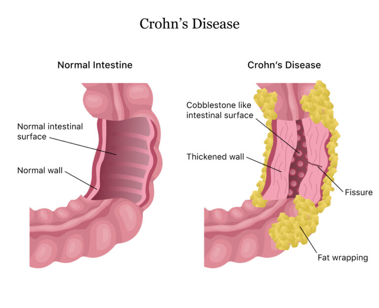 crohn's disease treatment