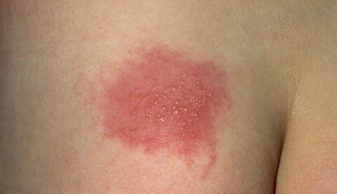 herpes