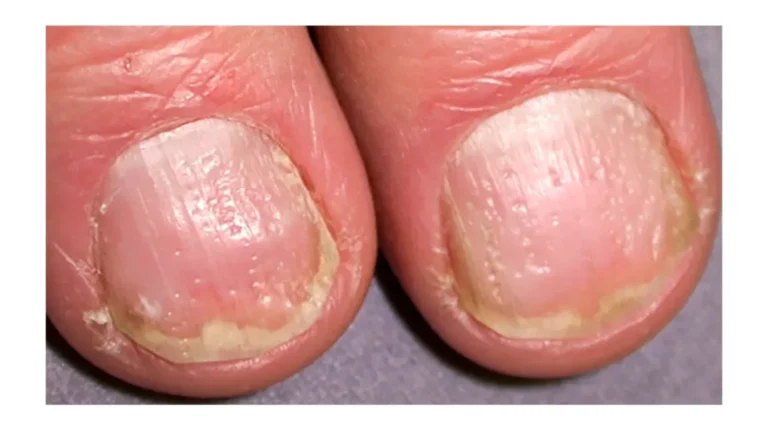 psoriatic arthritis