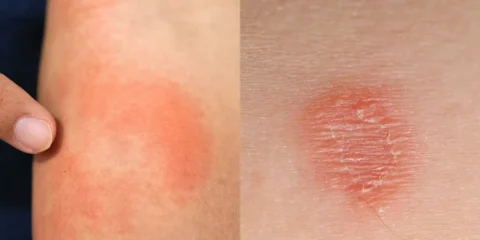 ringworm