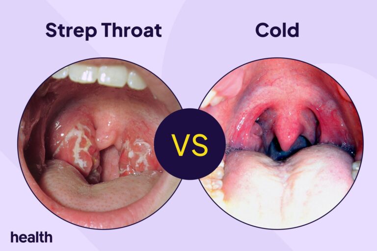 strep throat