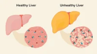 hepatic steatosis