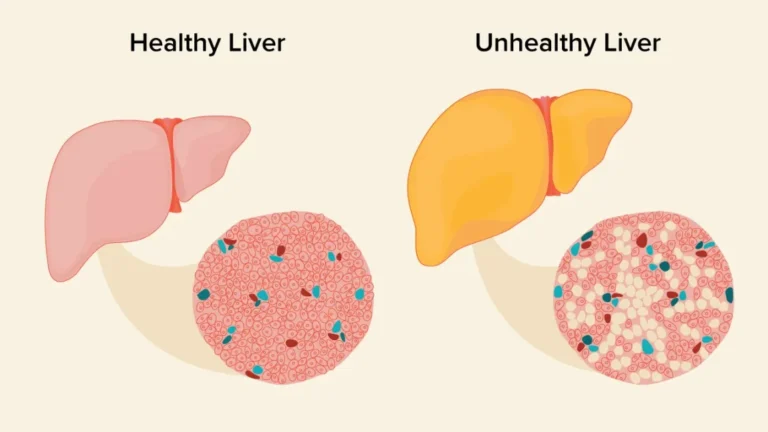 hepatic steatosis