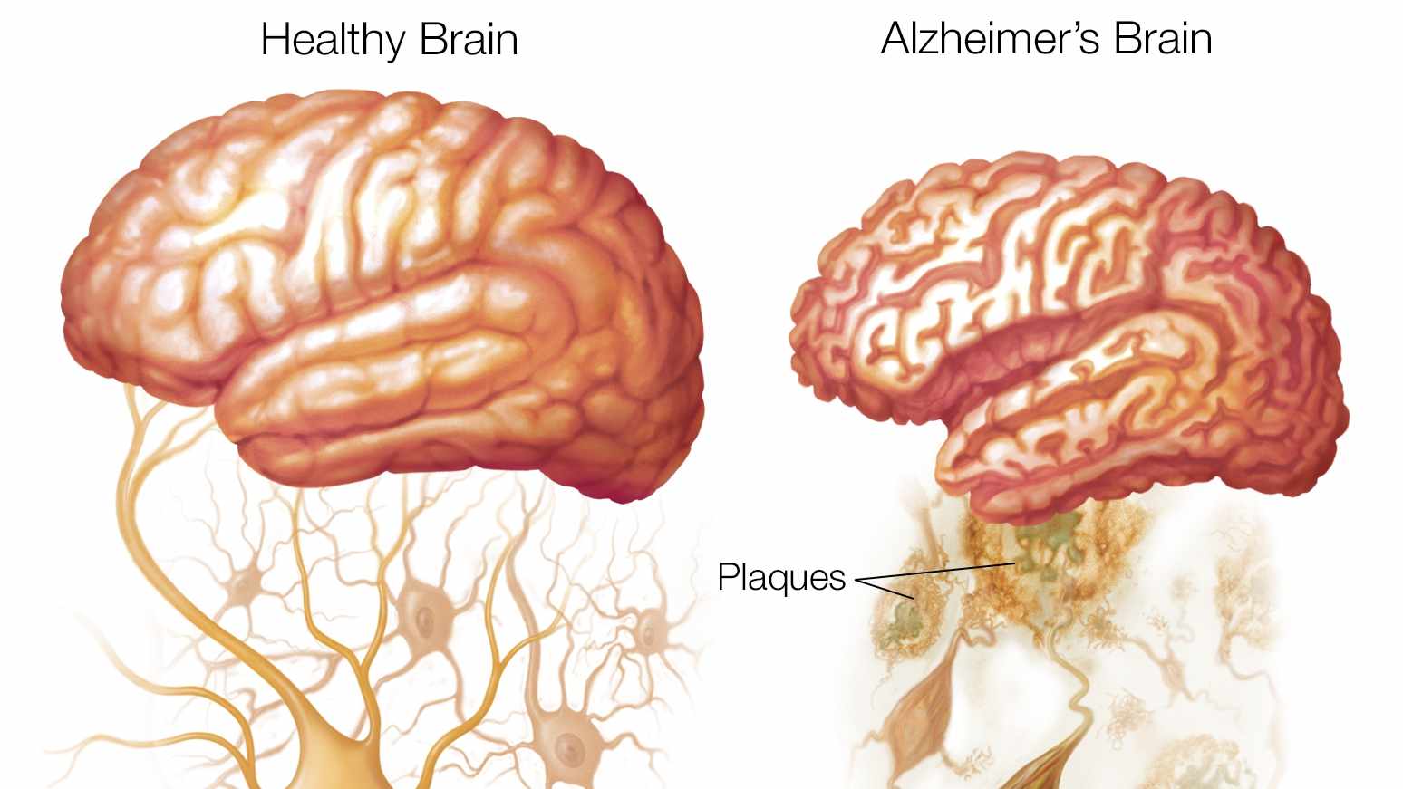amyloid