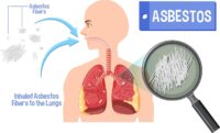 asbestosis