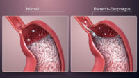 barrett's esophagus