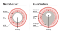 bronchiectasis