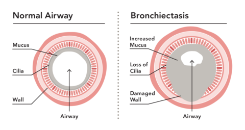 bronchiectasis