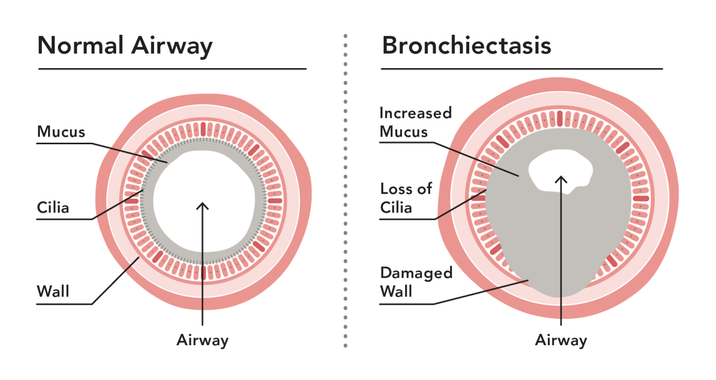 bronchiectasis