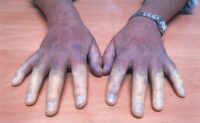 buerger's disease