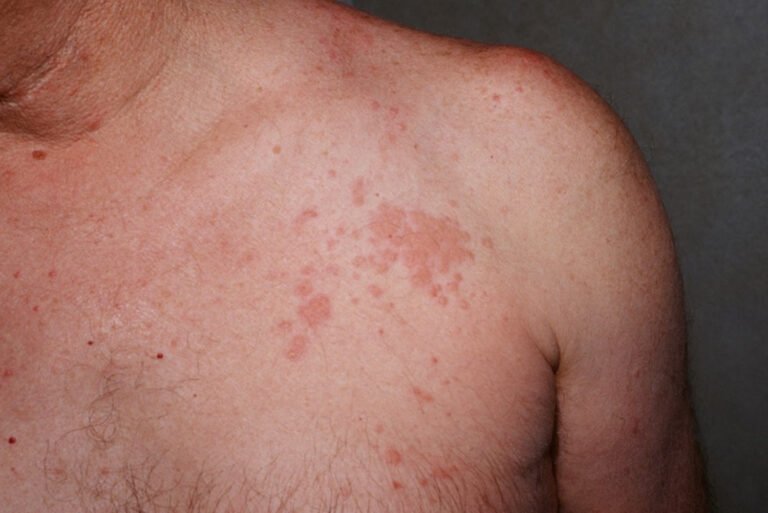 churg strauss syndrome