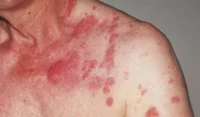 carcinoid syndrome