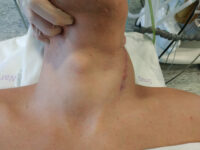 desmoid tumor