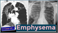 emphysema