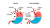 gastroparesis