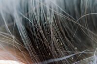head lice
