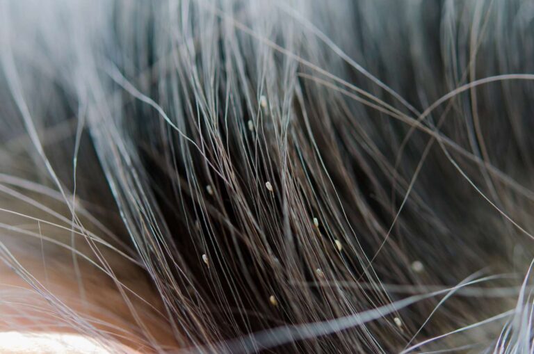 head lice