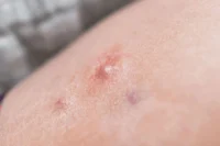 hs disease