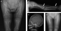 hypophosphatasia