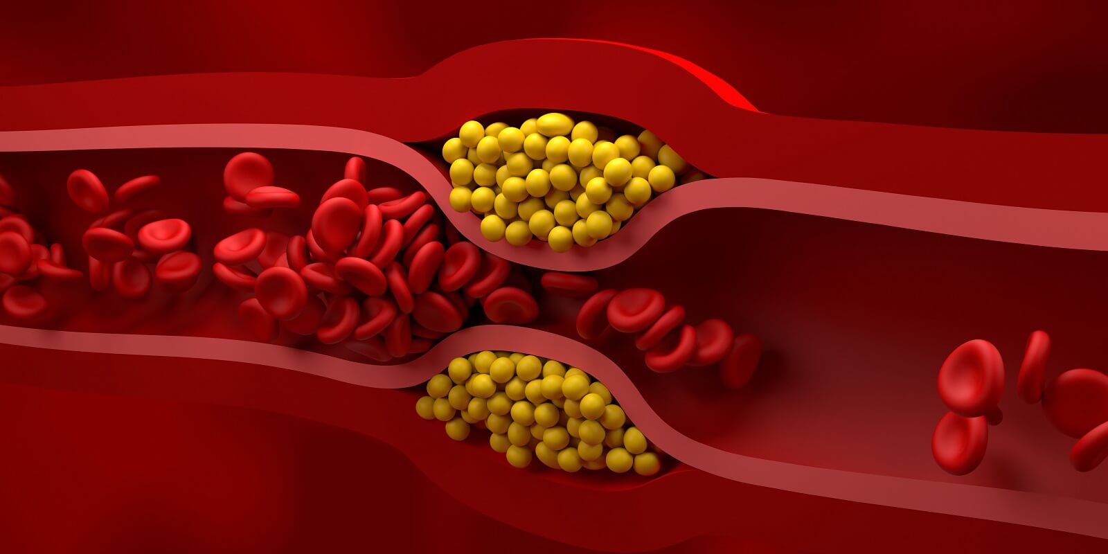 ldl cholesterol high