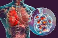 legionnaires disease