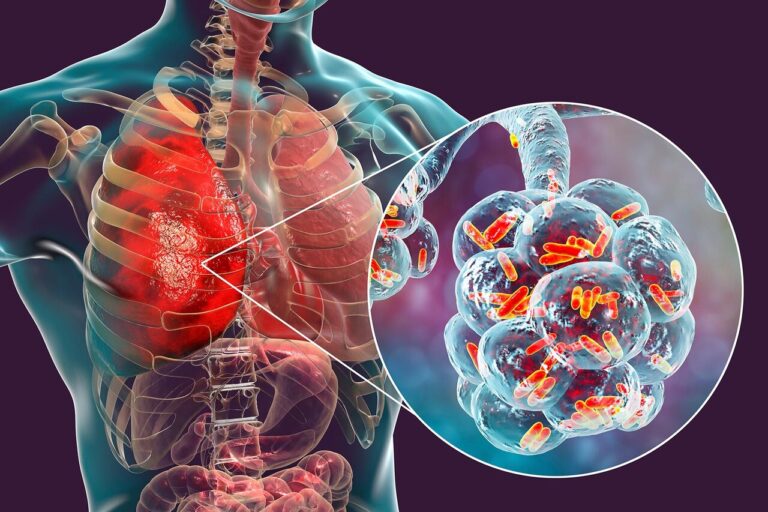 legionnaires disease