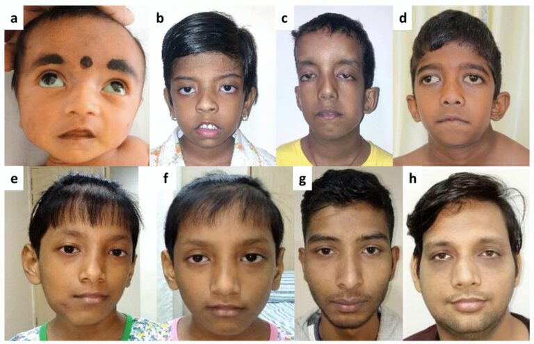 marfan syndrome