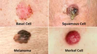 melanoma cancer