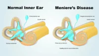 meniere's disease