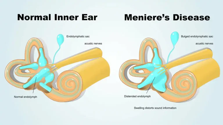 meniere's disease