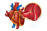 myocardial infarction