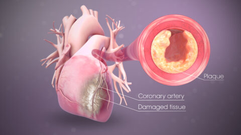 myocardial infarction symptoms