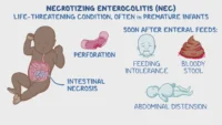 necrotizing enterocolitis