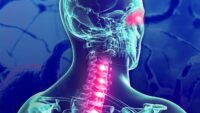 neuromyelitis optica
