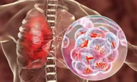 pneumococcal