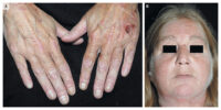 porphyria