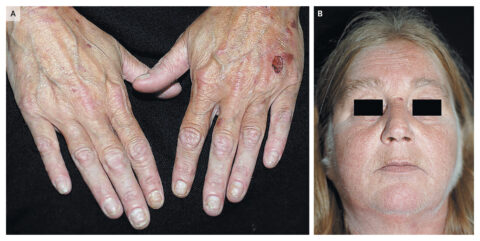 porphyria
