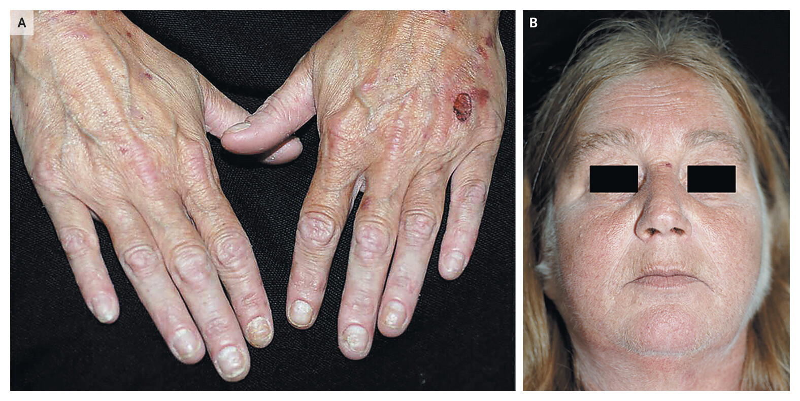 porphyria