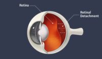 retinal