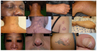 sarcoidosis