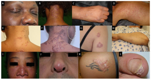 sarcoidosis