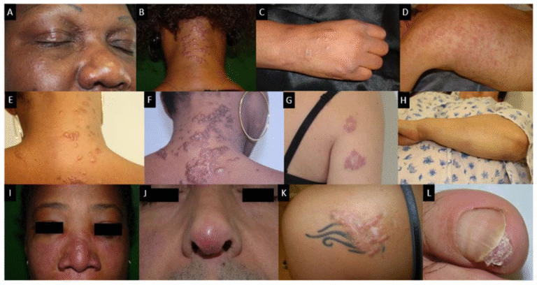 sarcoidosis