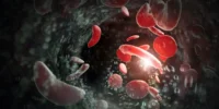 sickle cell disease