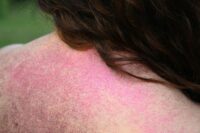 still's disease