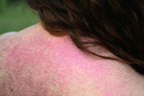 still's disease