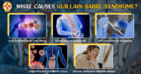 guillain barre syndrome