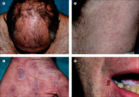 syphilis